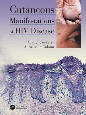cover image of Cutaneous Manifestations of HIV Disease